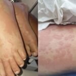 Menina de 10 anos é internada em Natal com suspeita de infecção por detergente Ypê