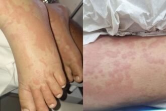 Menina de 10 anos é internada em Natal com suspeita de infecção por detergente Ypê