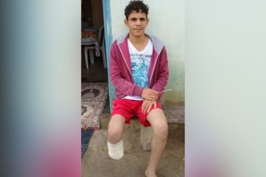 Homem é condenado após amputar o próprio pé para receber indenização de R$ 1,5 milhão de seguradoras